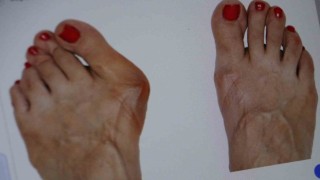 Topuklu ve sivri burun ayakkabı giyenler dikkat: Parmağınızın anatomisi bozulabilir